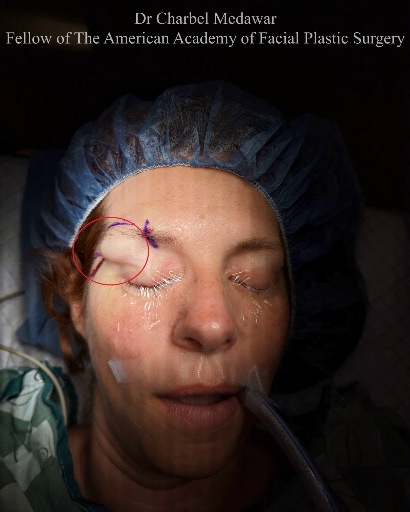 surgery reconstructive skin cancer case facial cosmetic surgery facial plastic surgeon dr charbel medawar style beauty clinic beirut lebanon dubai top surgeon