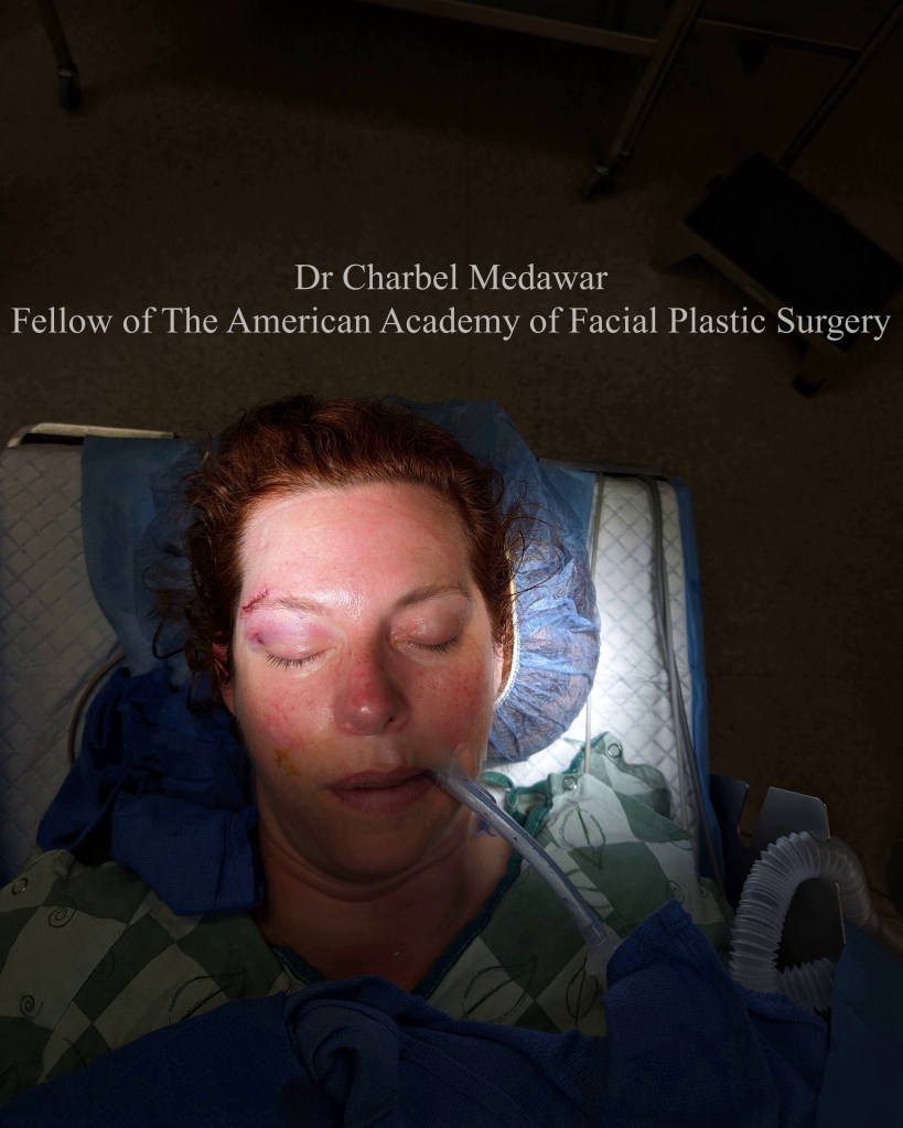 facial plastic surgery lebanon reconstructive skin cancer case facial cosmetic surgery facial plastic surgeon dr charbel medawar style beauty clinic beirut lebanon dubai top surgeon