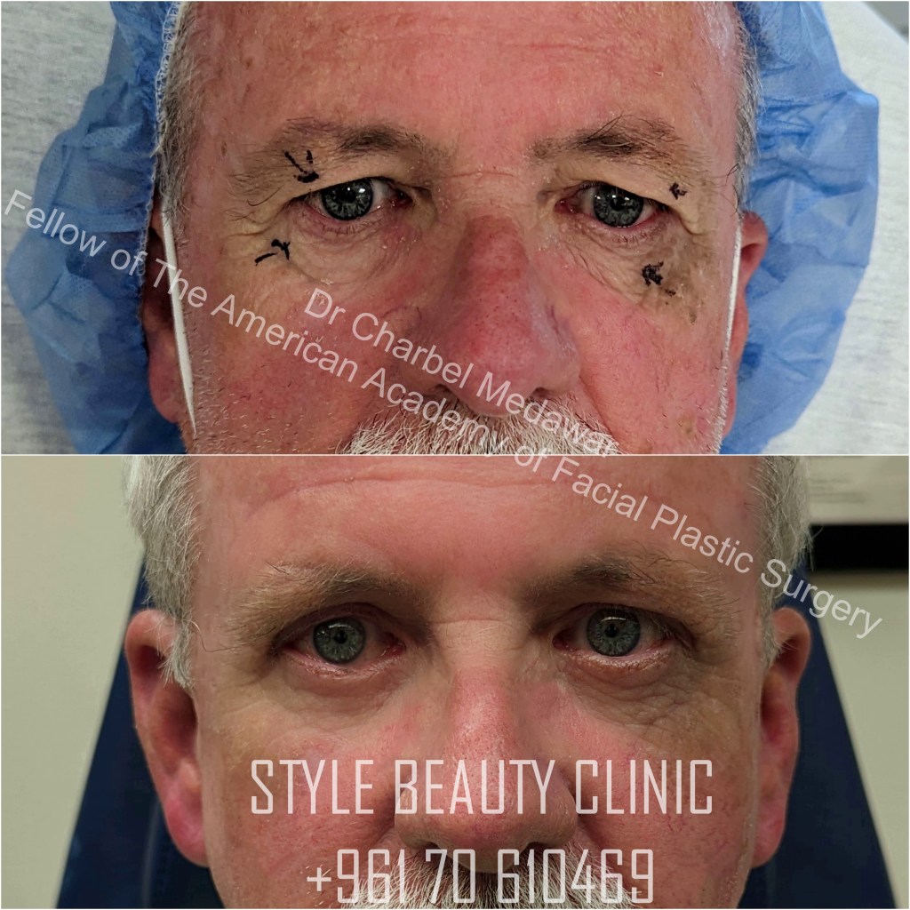 dr charbel medawar browlift beirut lebanon plastic surgery
