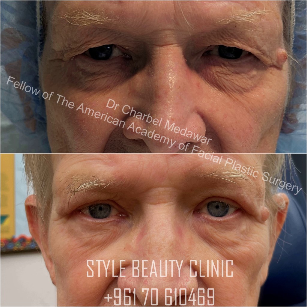eyelid surgery blepharoplasty browlift upper and lower fat pad removal dr charbel medawar 
