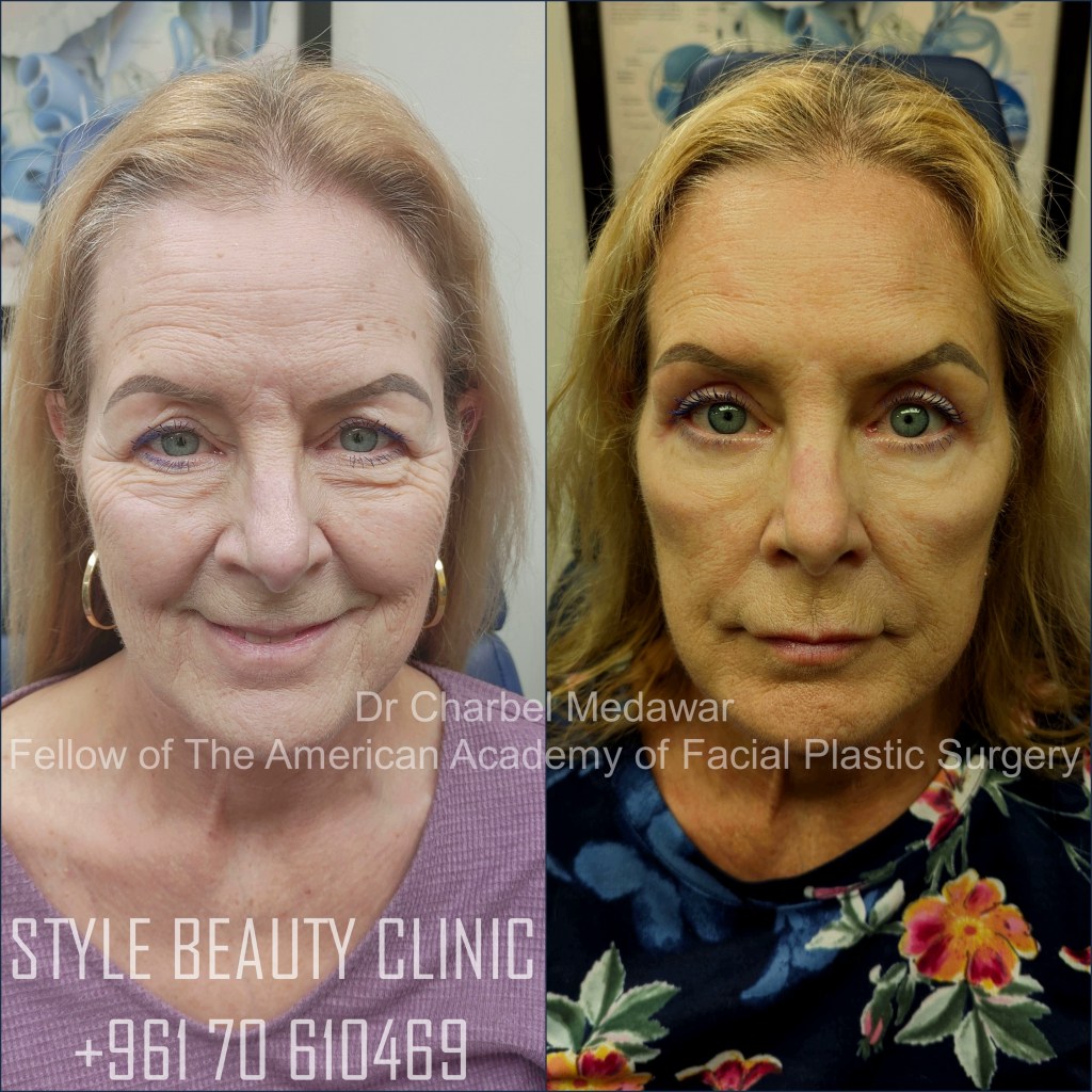 blepharoplasty browlift upper and lower fat pad removal dr charbel medawar facial plastic surgeon style beauty clinic beirut lebanon