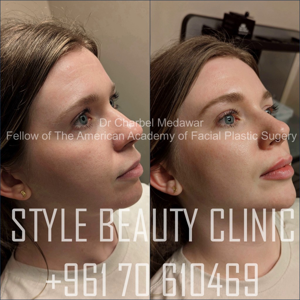 jawline filler contouring dr charbel medawar top plastic surgery lebanon