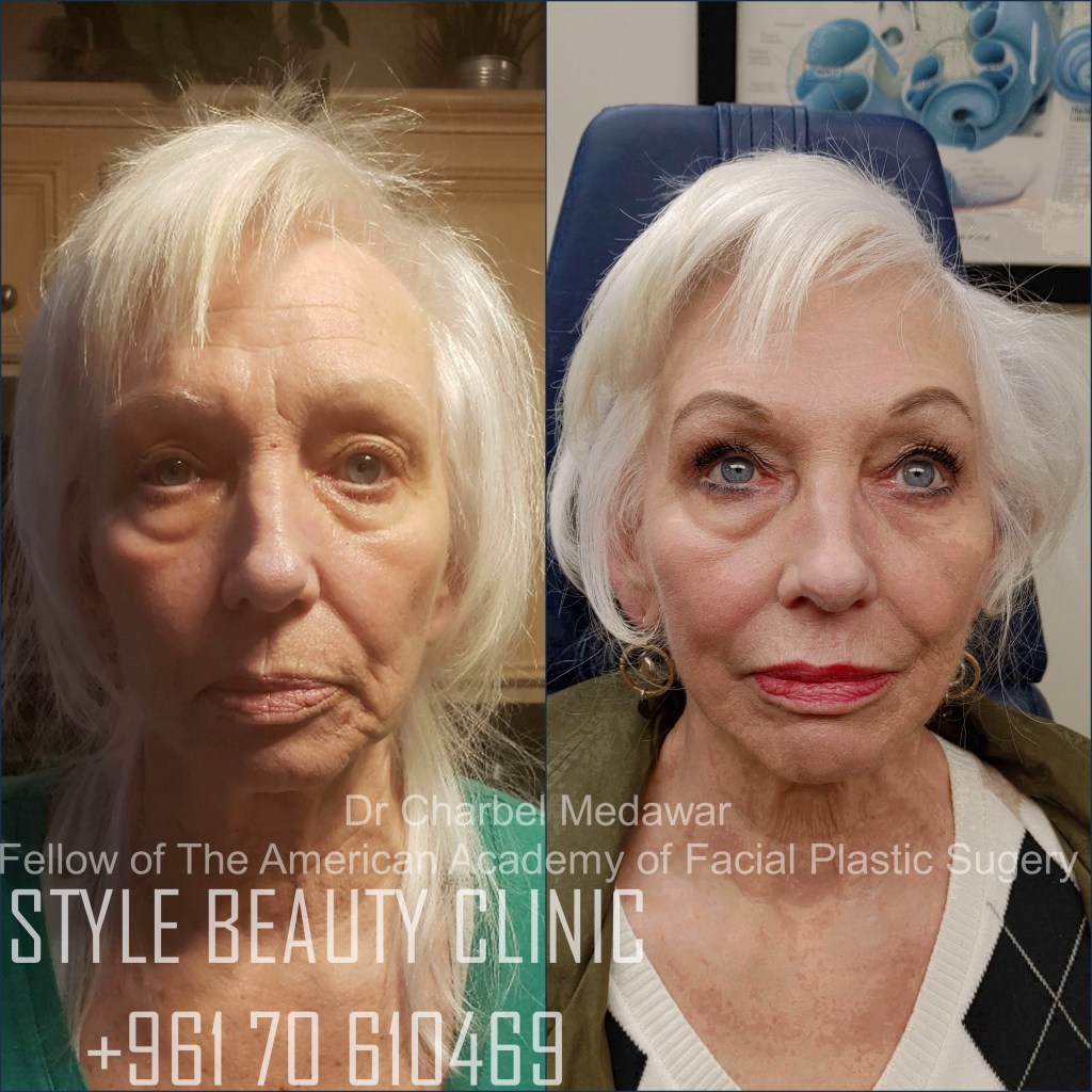 liquid facelift cheek lift jawline contouring fillers botox dr charbel medawar plastic surgery beirut lebanon style beauty clinic