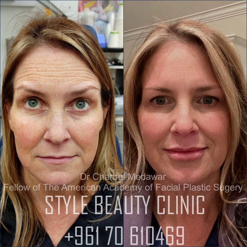 liquid facelift cheek lift jawline contouring fillers botox dr charbel medawar plastic surgery beirut lebanon style beauty clinic