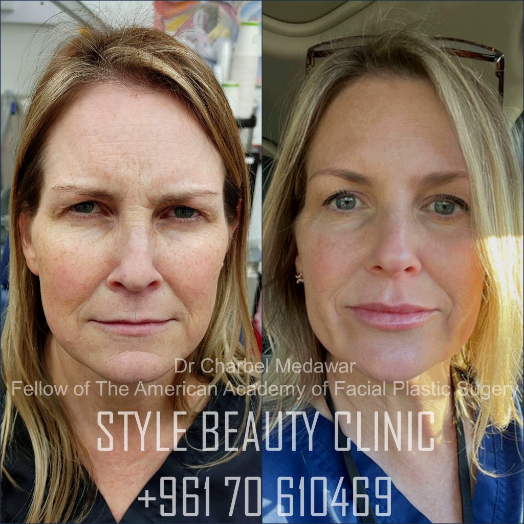 liquid facelift cheek lift jawline contouring fillers botox dr charbel medawar plastic surgery beirut lebanon style beauty clinic