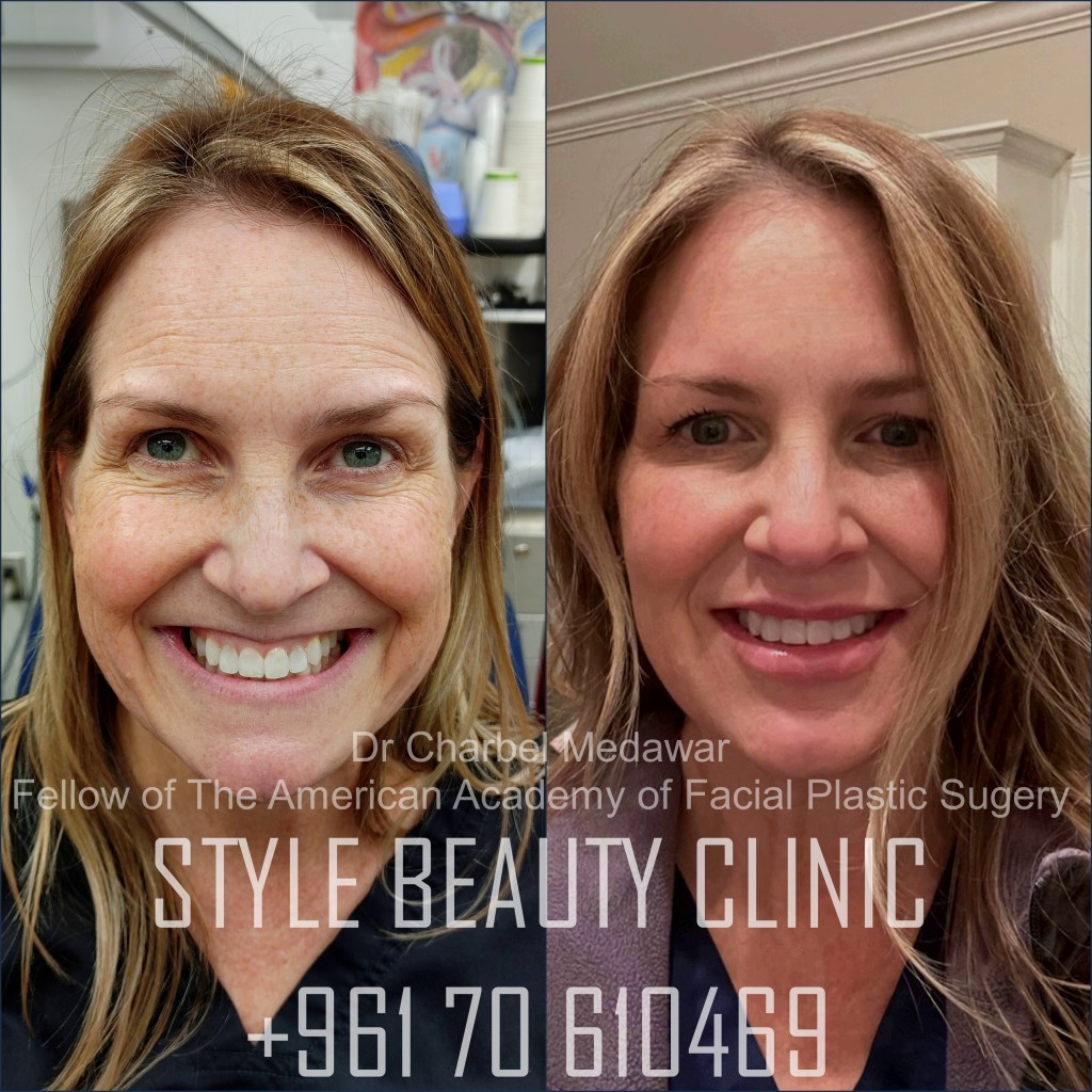 liquid facelift cheek lift jawline contouring fillers botox dr charbel medawar plastic surgery beirut lebanon style beauty clinic