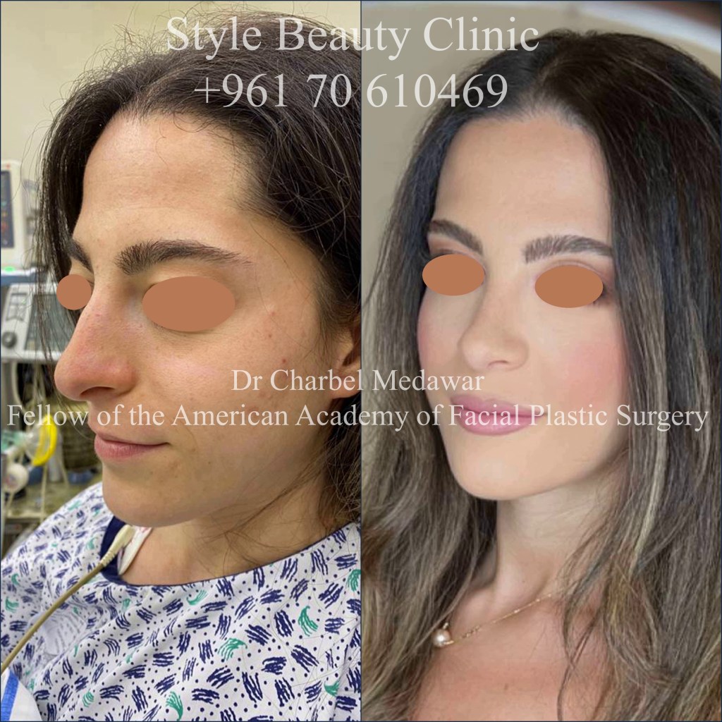 Dr Charbel Medawar Rhinoplasty Nosejob style beauty clinic top facial plastic surgeon beirut lebanon middle east dubai