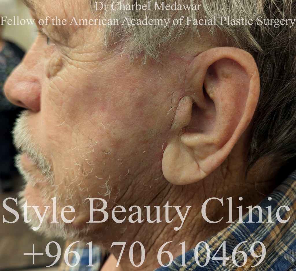 surgical facelift beirut Lebanon dr charbel medawar scar