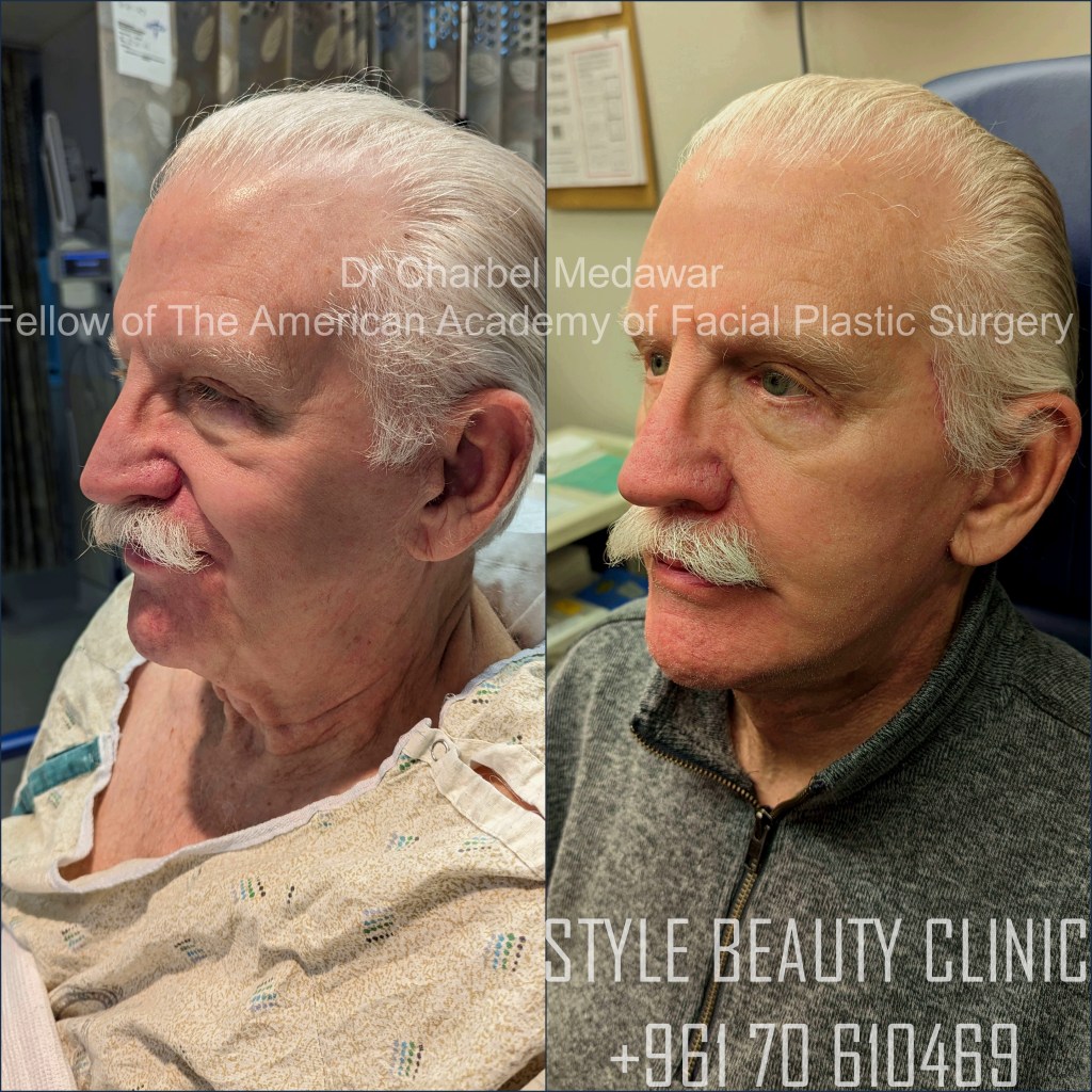 Dr. Nabil Mokhtar, deep plane facelift surgeon in Cairo, Egypt