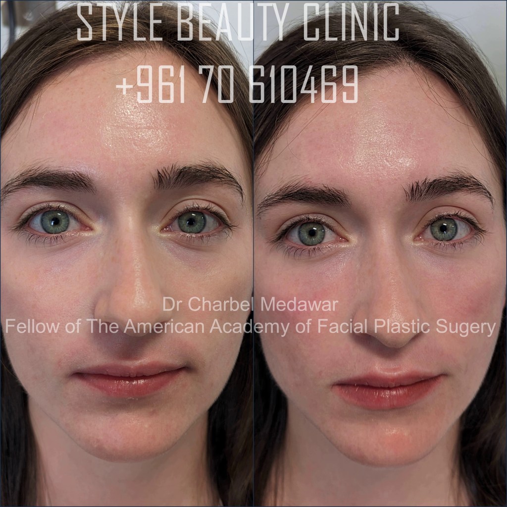 tear trough under eye fillers  dr charbel medawar beirut lebanon