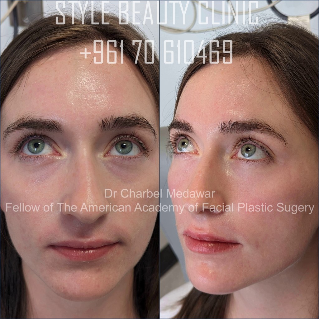 tear trough under eye fillers  dr charbel medawar