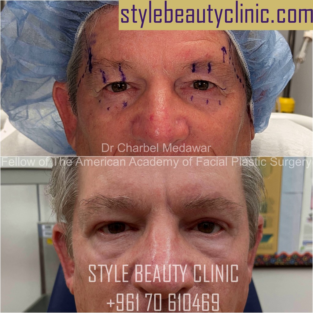 blepharoplasty browlift dr charbel medawar facial plastic surgeon style beauty clinic beirut lebanon