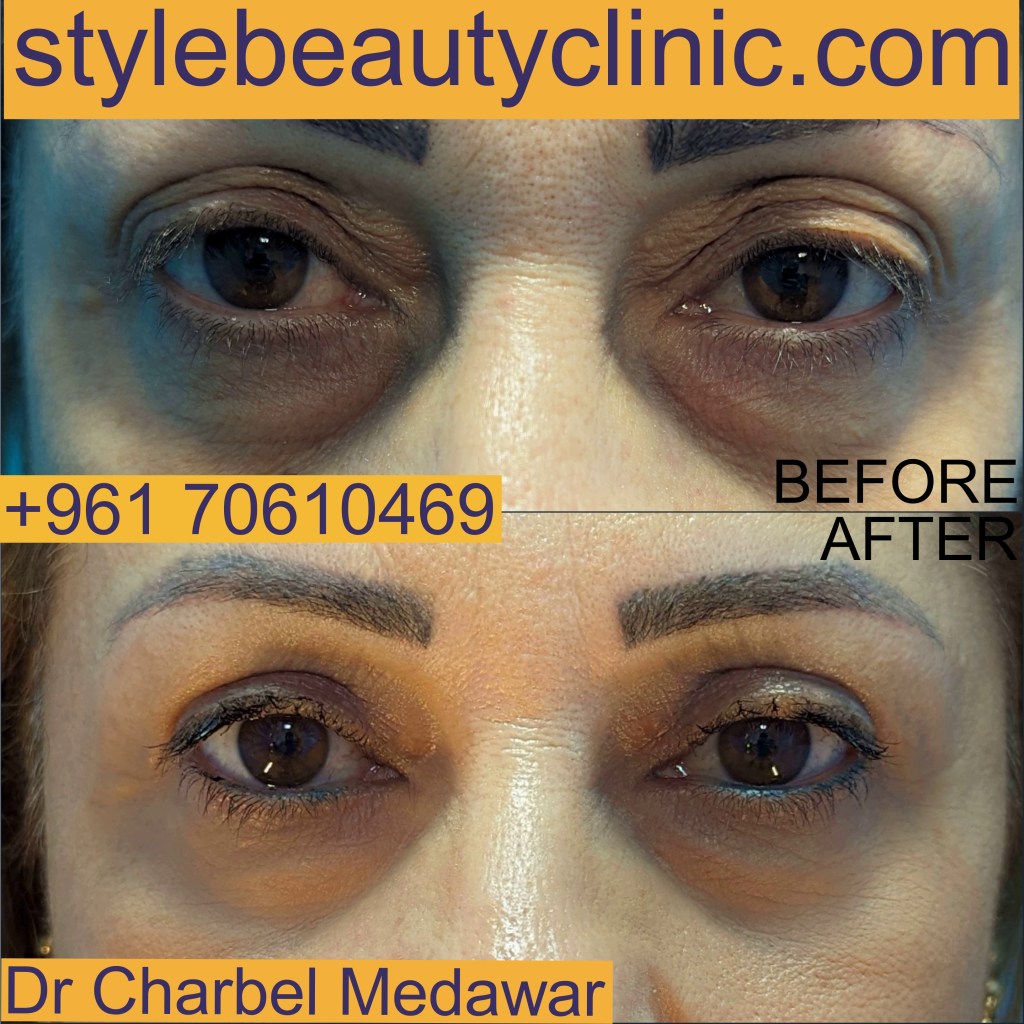 dr charbel medawar blepharoplasty surgery lebanon style beauty clinic