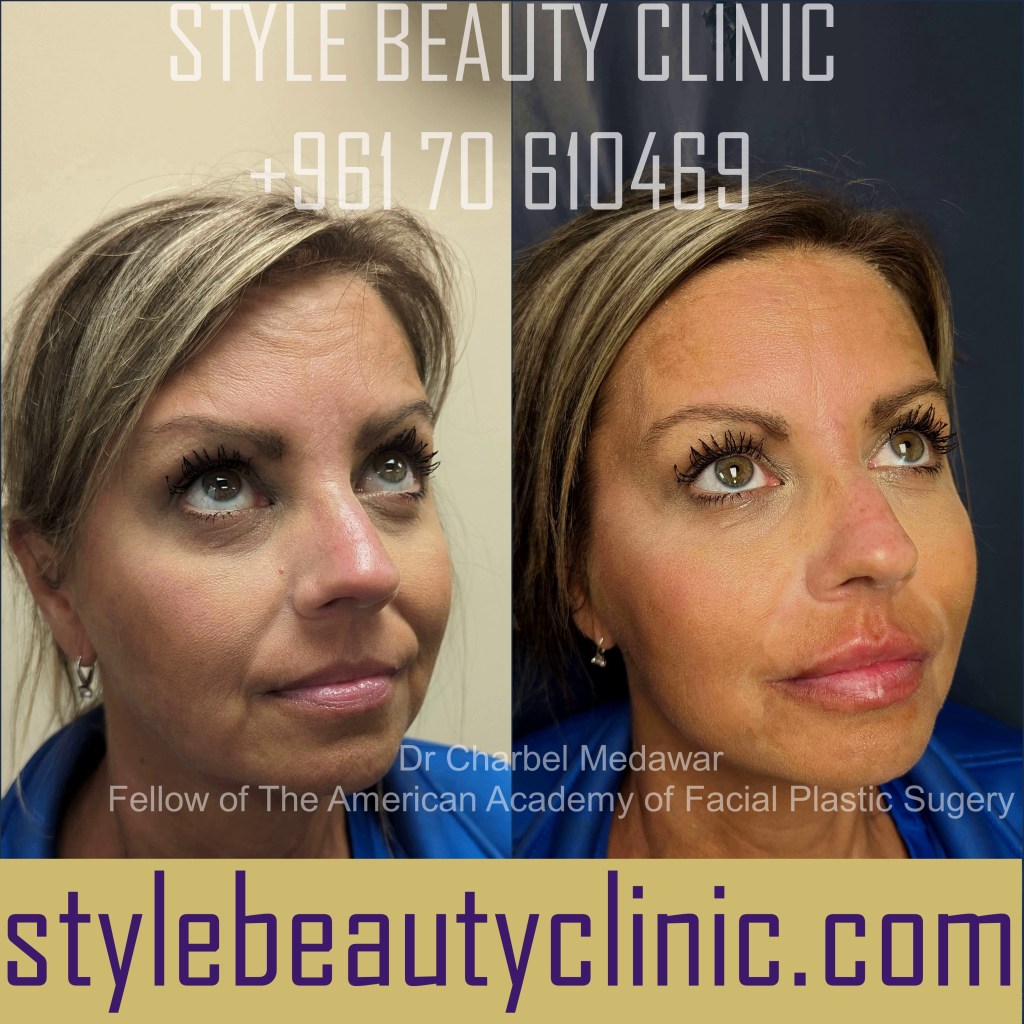 dr charbel medawar facelift plastic surgery lebanon
