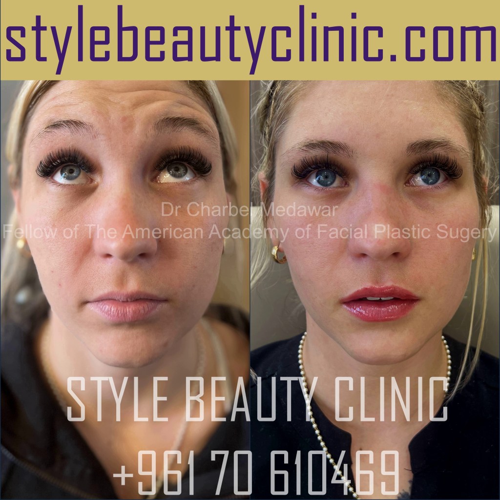 dr charbel medawar lip fillers botox beirut lebanon plastic surgery style beauty clinic