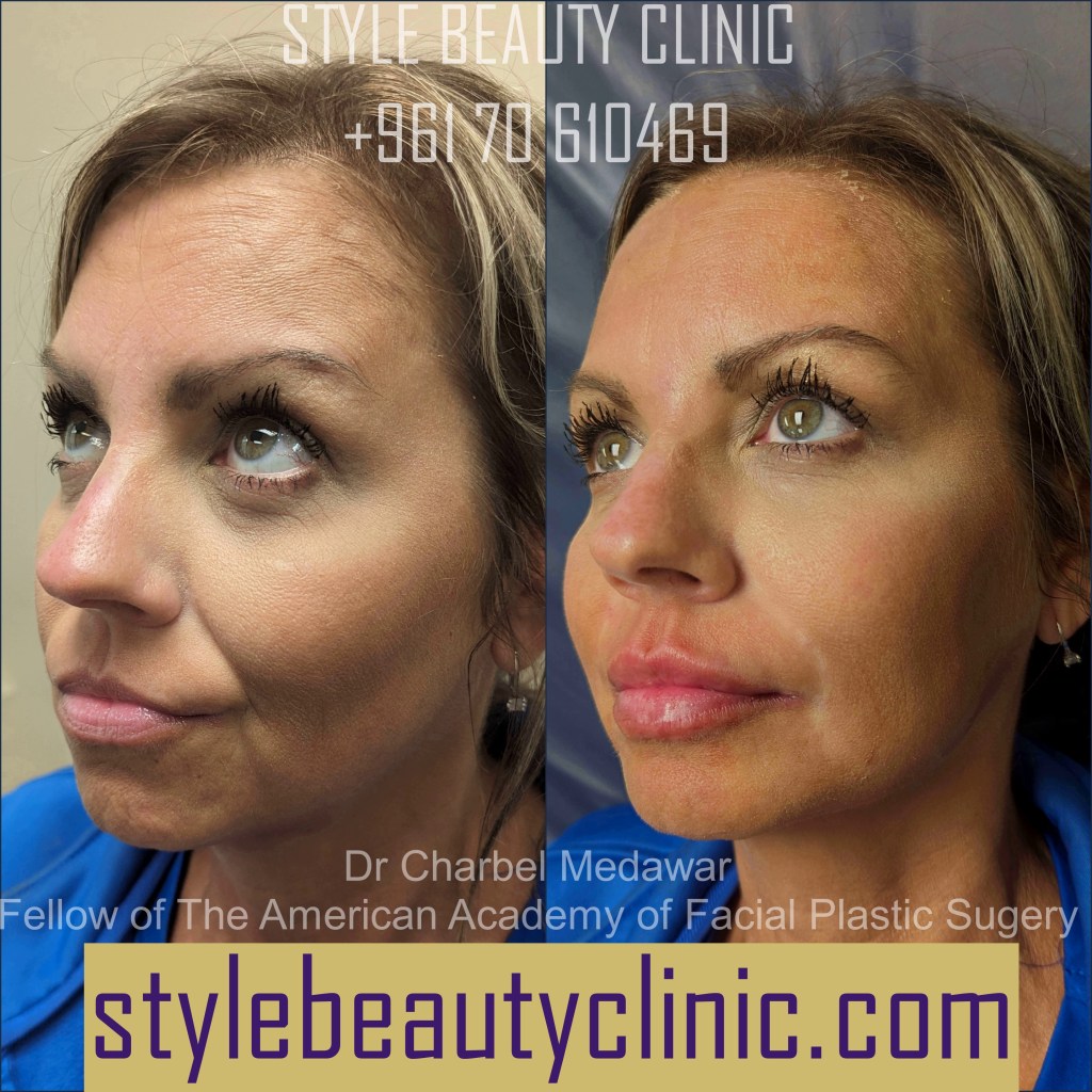 dr charbel medawar lip fillers top plastic surgeon lebanon