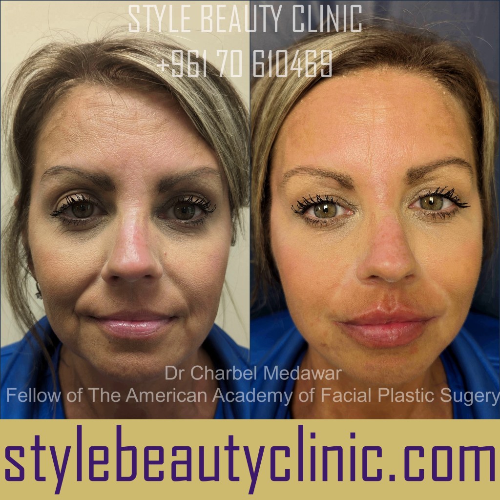 dr charbel medawar liquid facelift lebanon