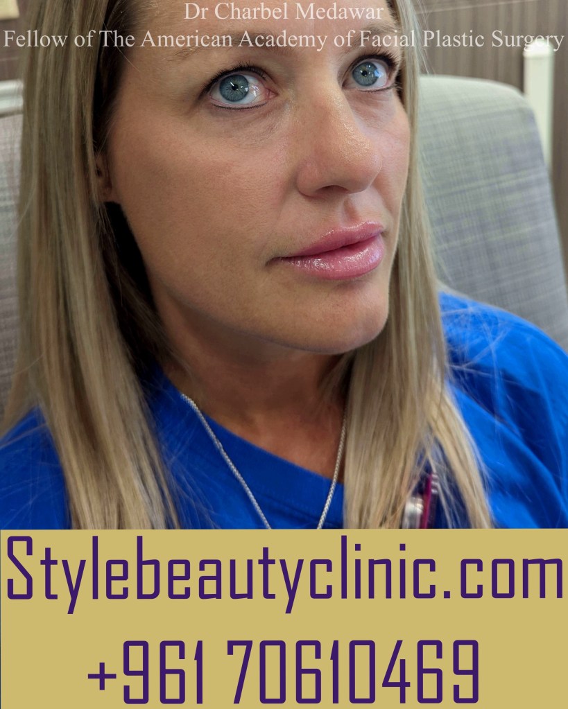 dr charbel medawar plastic surgery lebanon style beauty clinic lip fillers