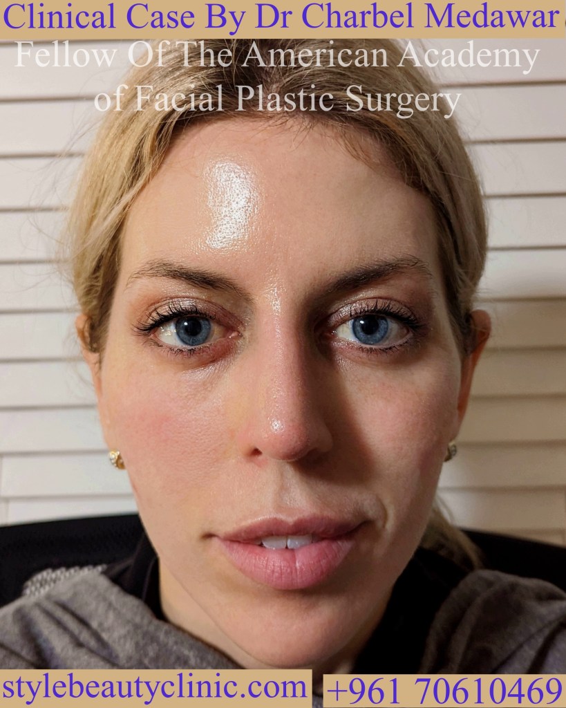 doctor charbel medawar blepharoplasty surgery