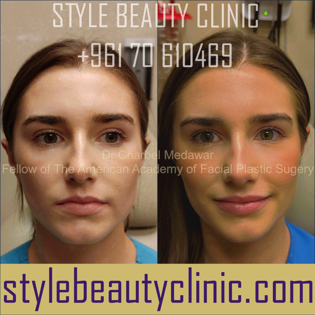 best lip fillers lebanon dr charbel medawar plastic surgery