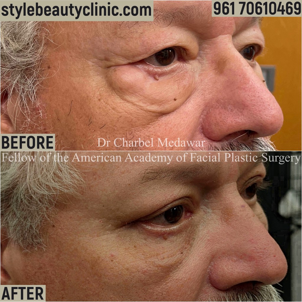 DR CHARBEL MEDAWAR LOWER BLEPHAROPLASTY