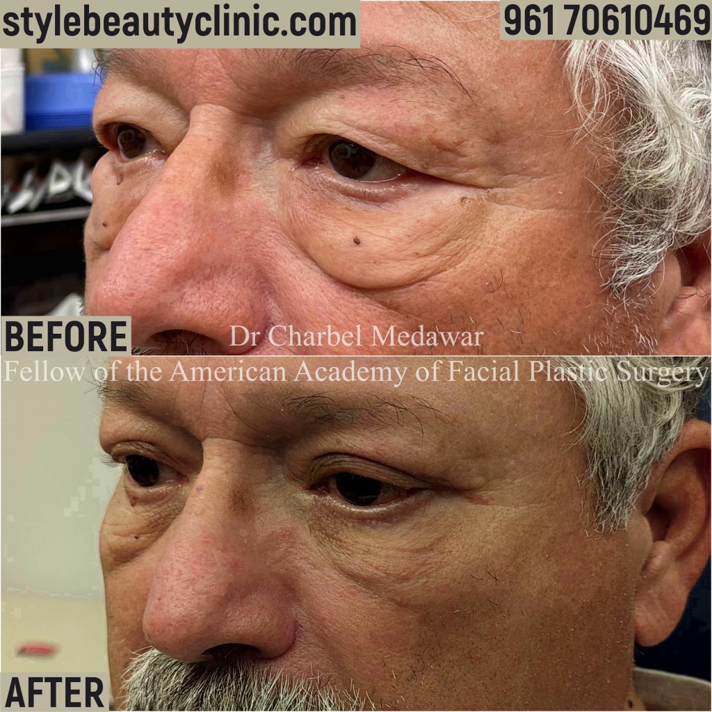 DR CHARBEL MEDAWAR LOWER BLEPHAROPLASTY LEBANON STYLE BEAUTY CLINIC 