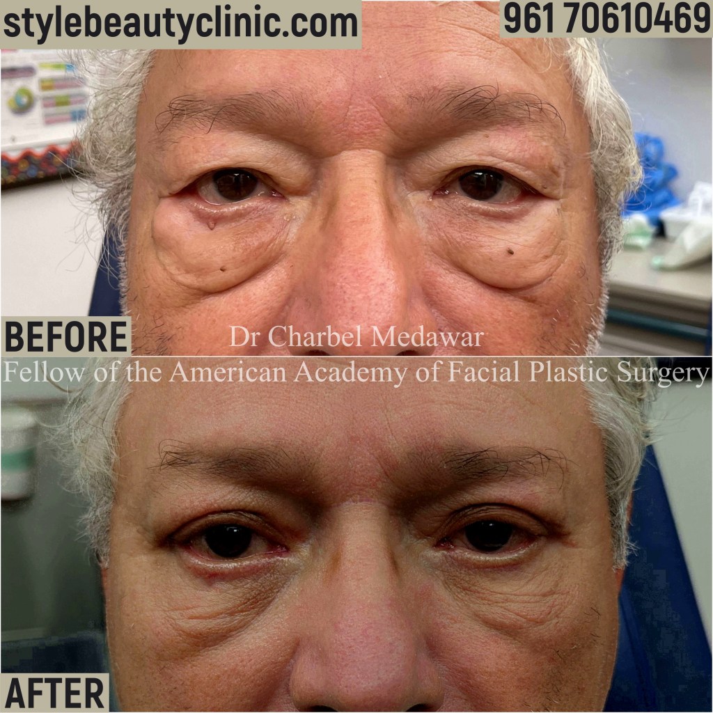DR CHARBEL MEDAWAR LOWER BLEPHAROPLASTY LEBANON
