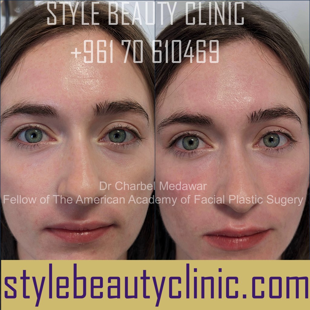 tear trough under eye fillers blepharoplasty browlift botox style beauty clinic dr charbel medawar beirut lebanon