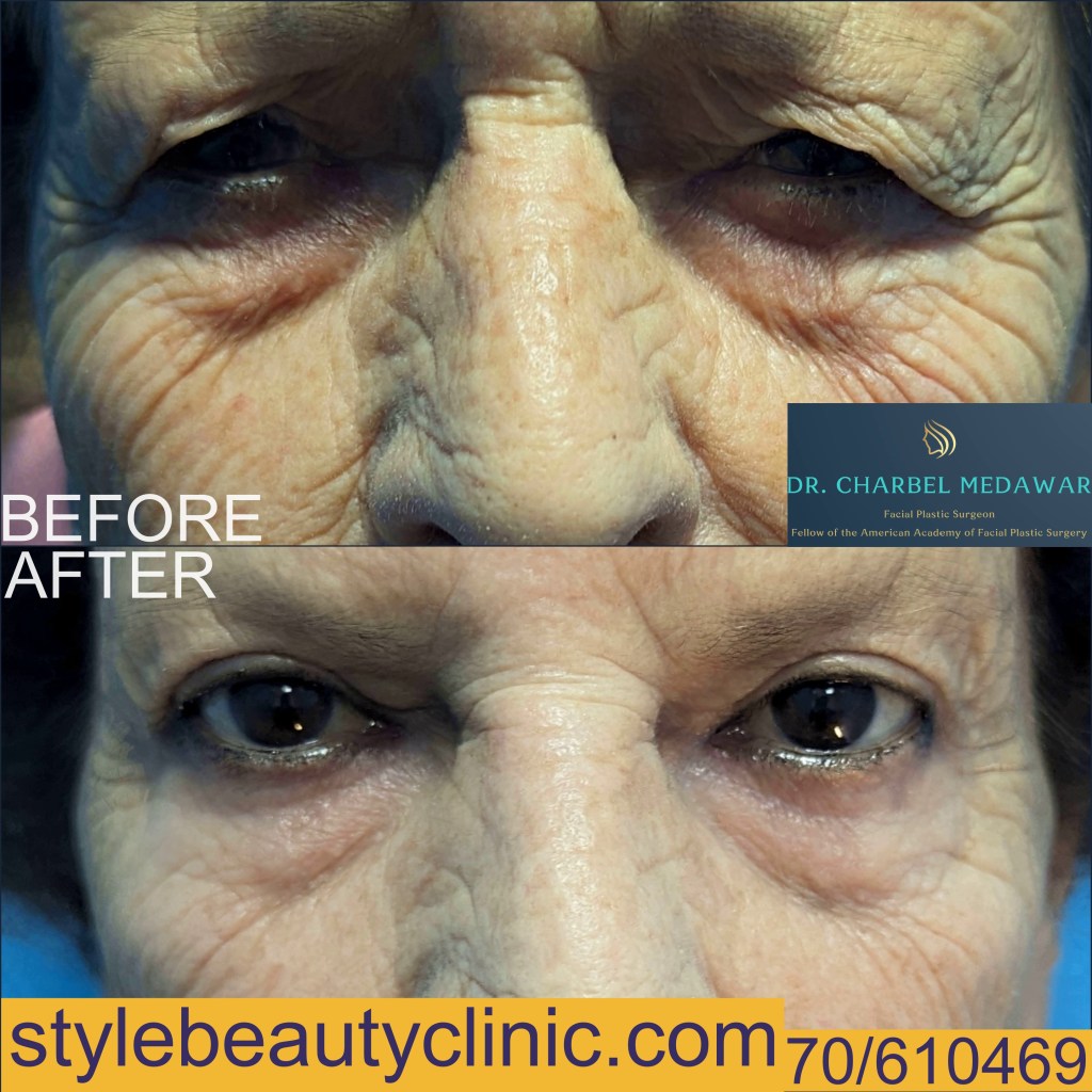 blepharoplasty lebanon dr charbel medawar plastic surgery