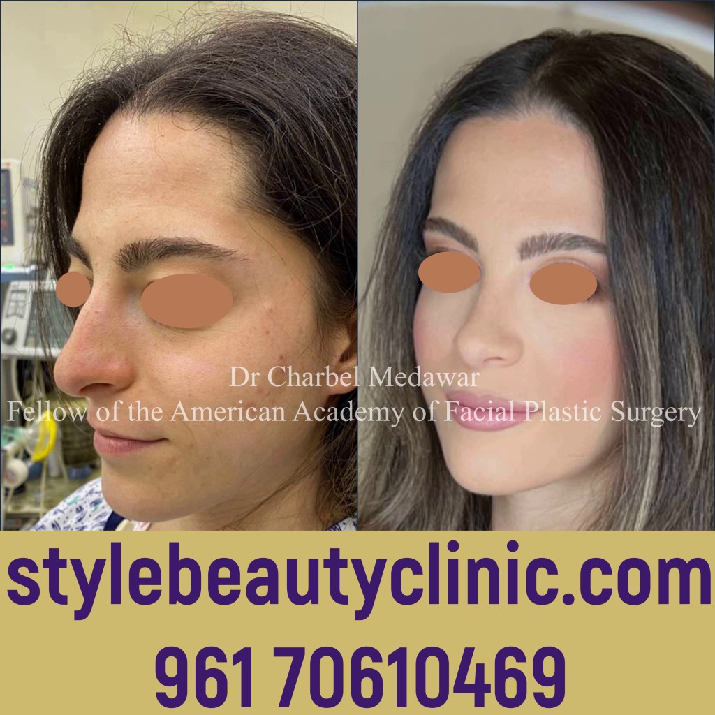 dr charbel medawar rhinoplasty master lebanon