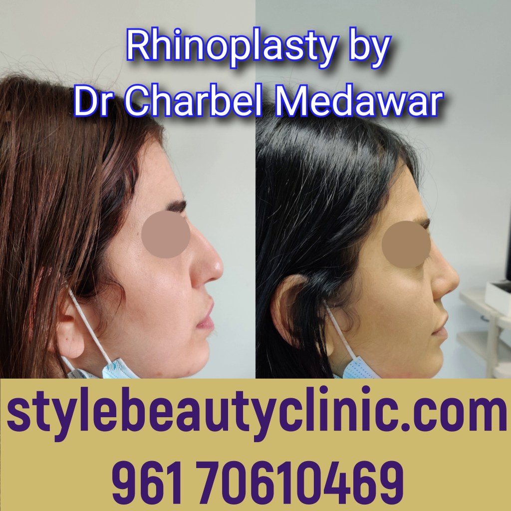 expert rhinoplasty doctor in lebanon dr charbel medawar
