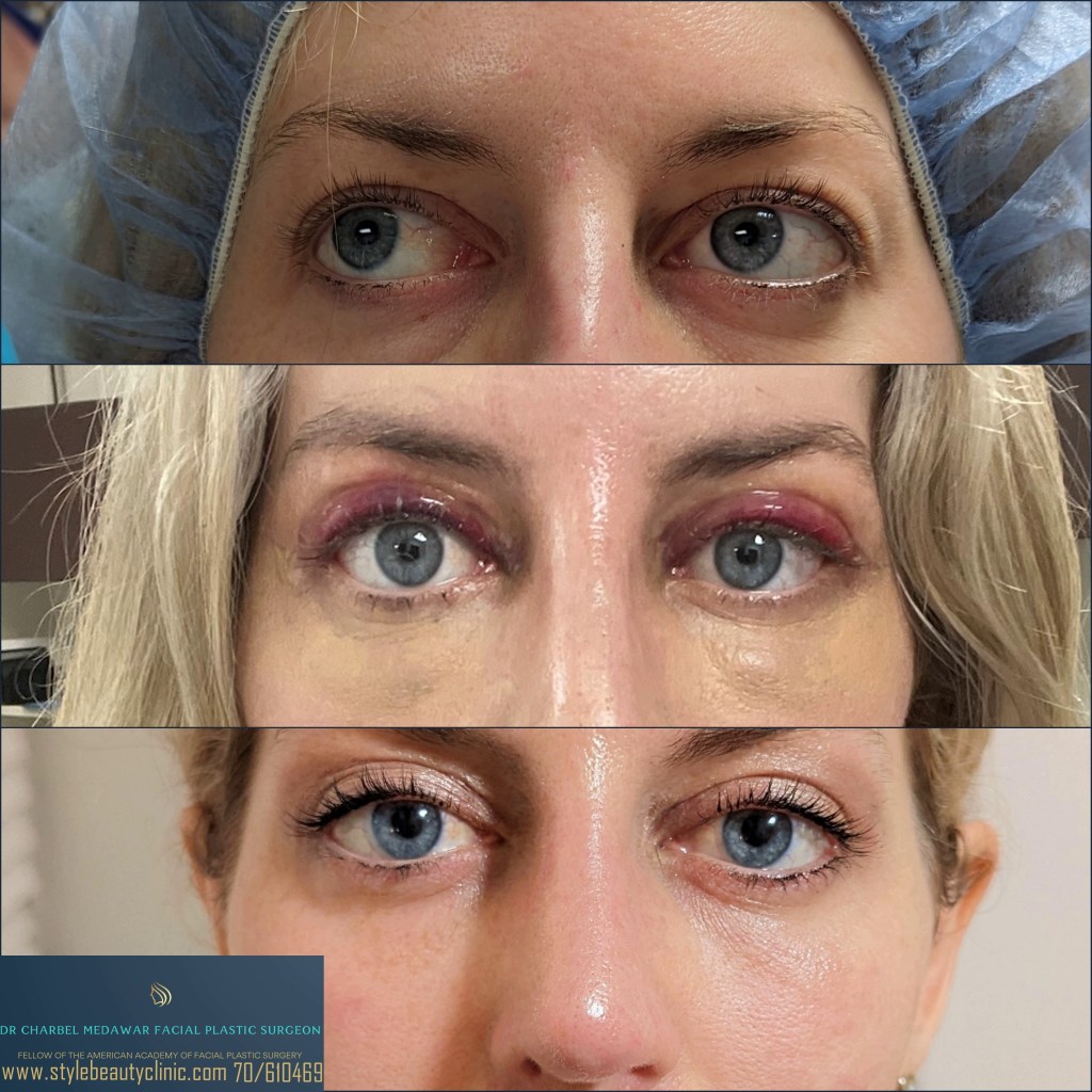 blepharoplasty doctor charbel medawar