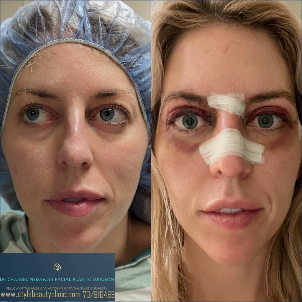 doctor charbel medawar blepharoplasty surgery