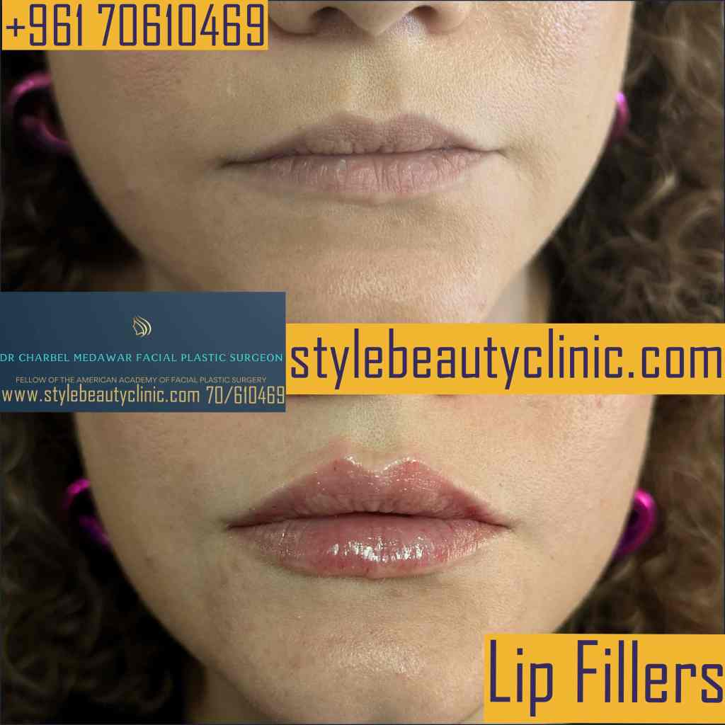 lip fillers lebanon dr charbel medawar