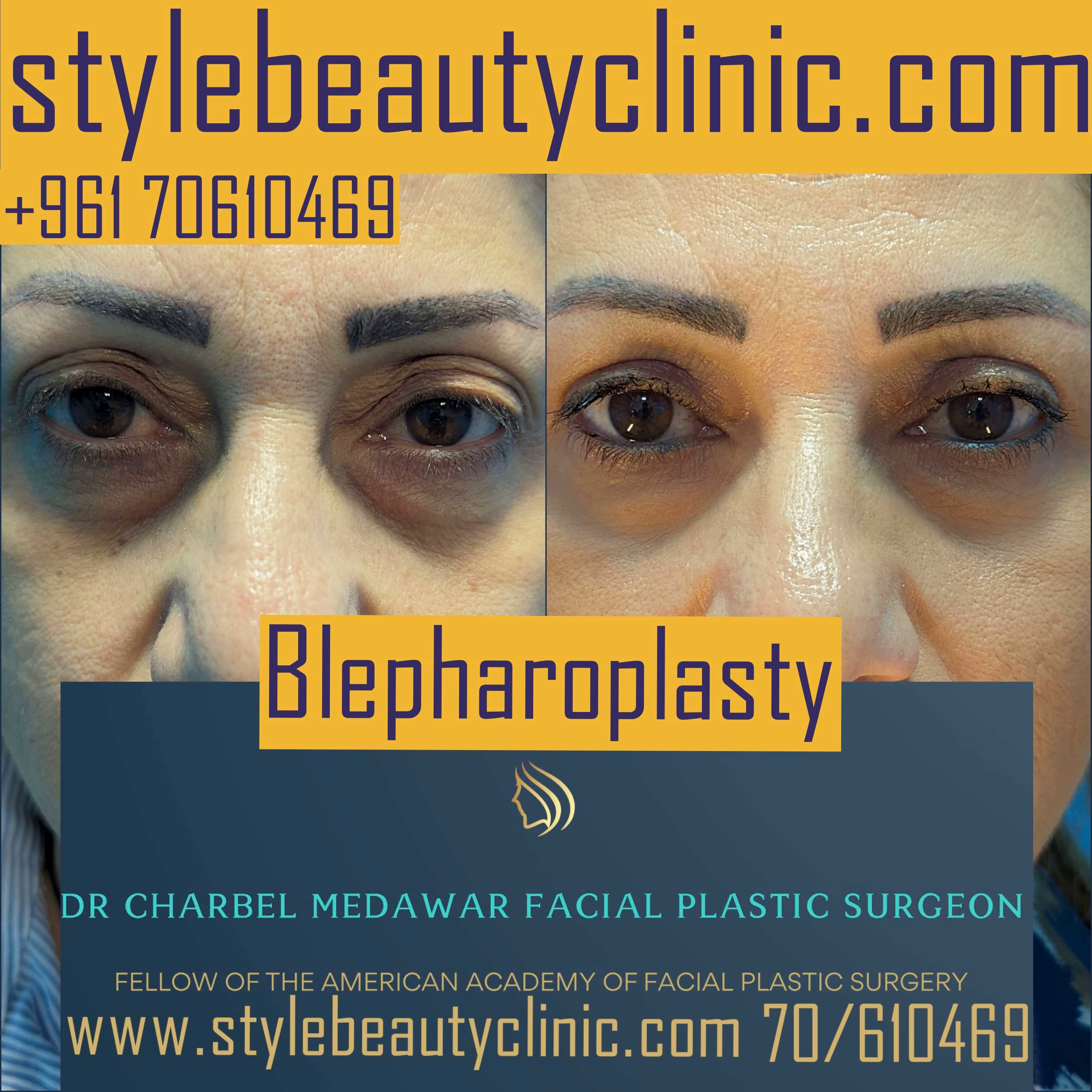 blepharoplasty surgeries in Lebanon