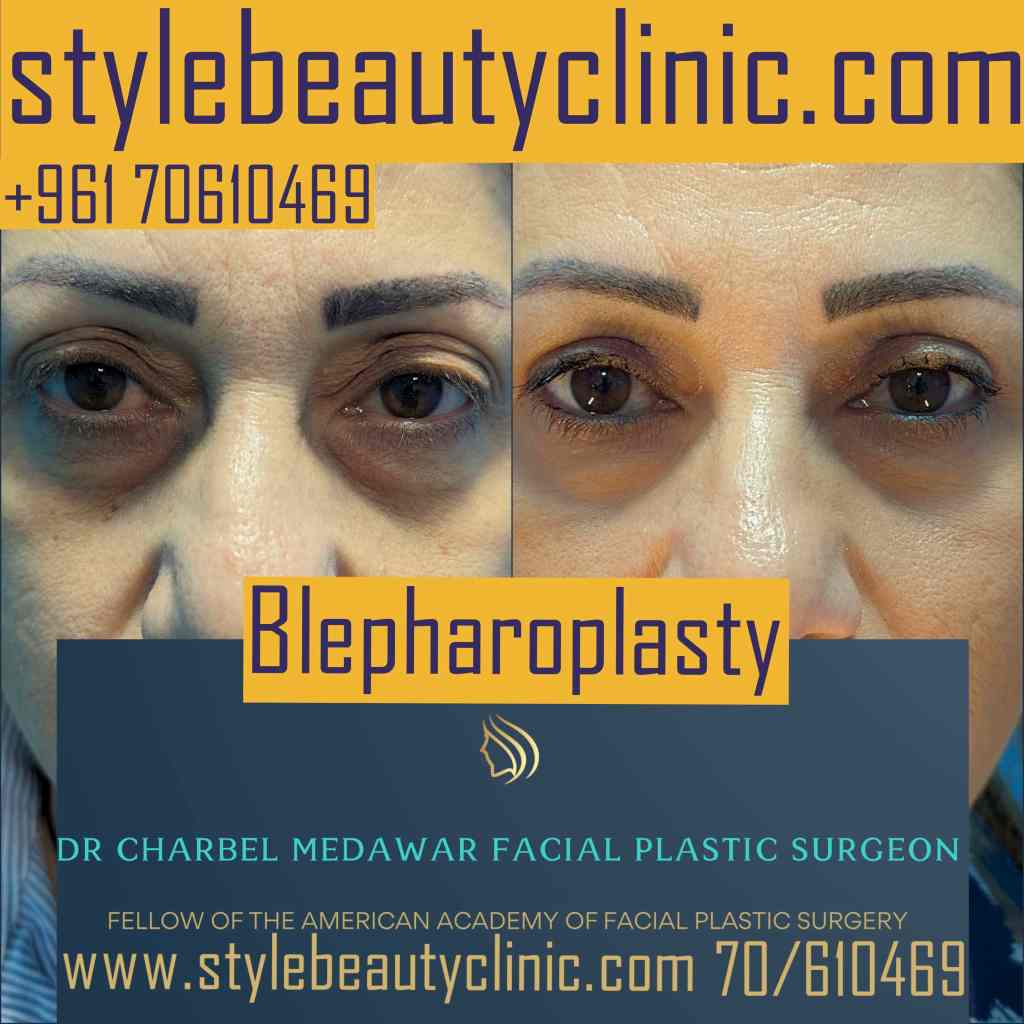 blepharoplasty surgeries in Lebanon