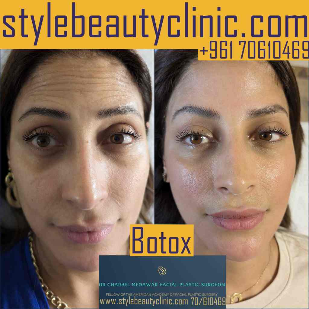 botox for hooded eyes lebanon