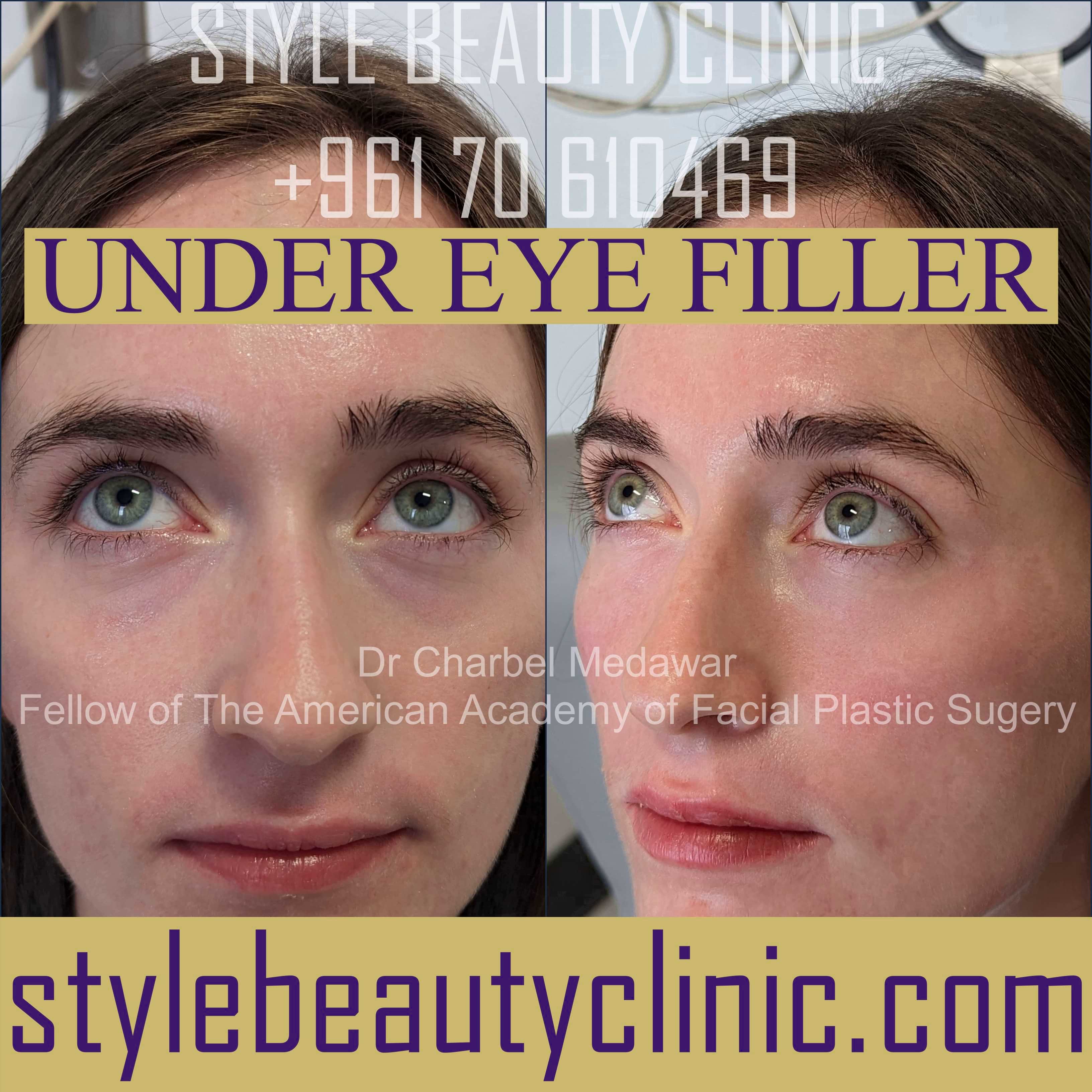 eyelid cosmetic surgery lebanon