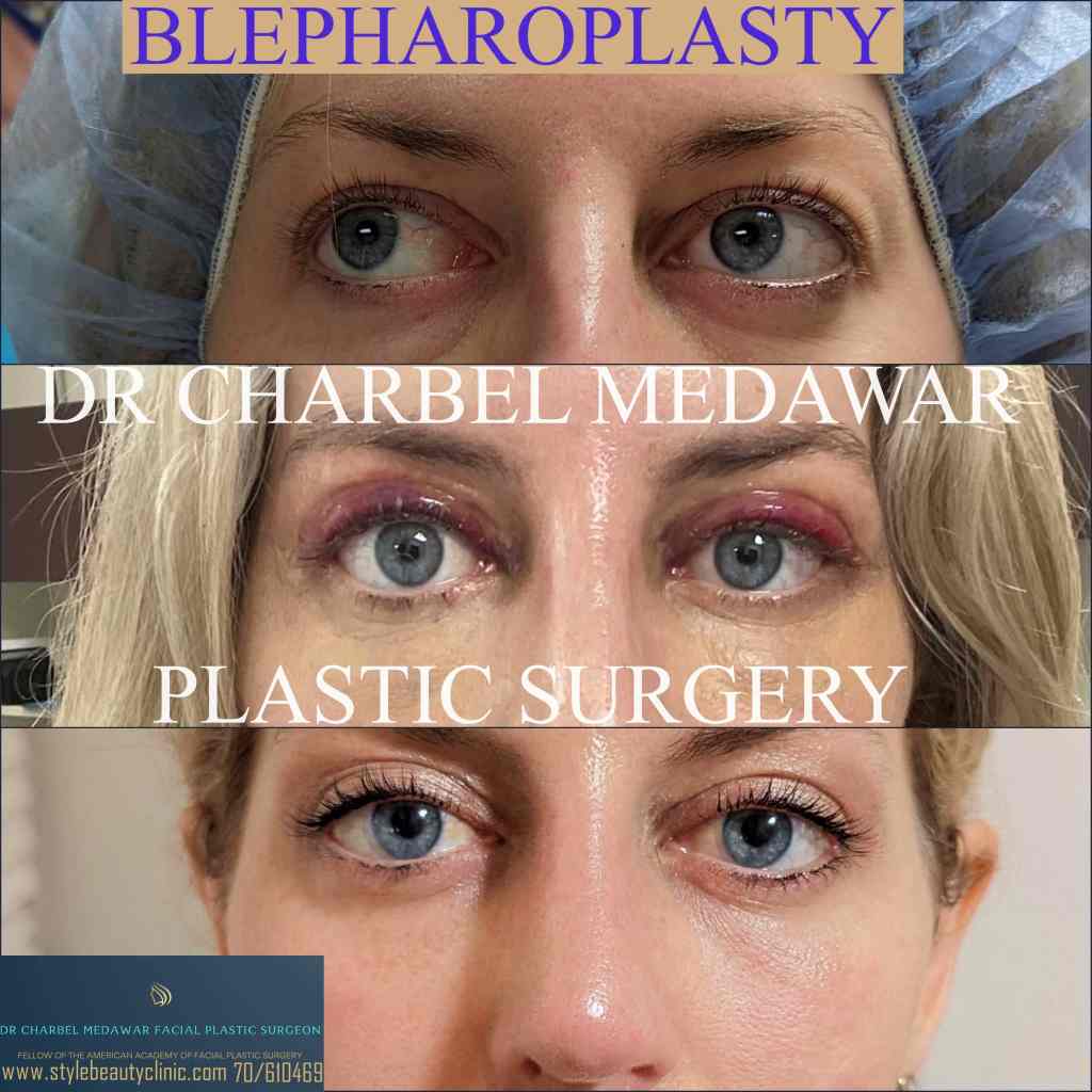eyelid lift surgery in lebanon