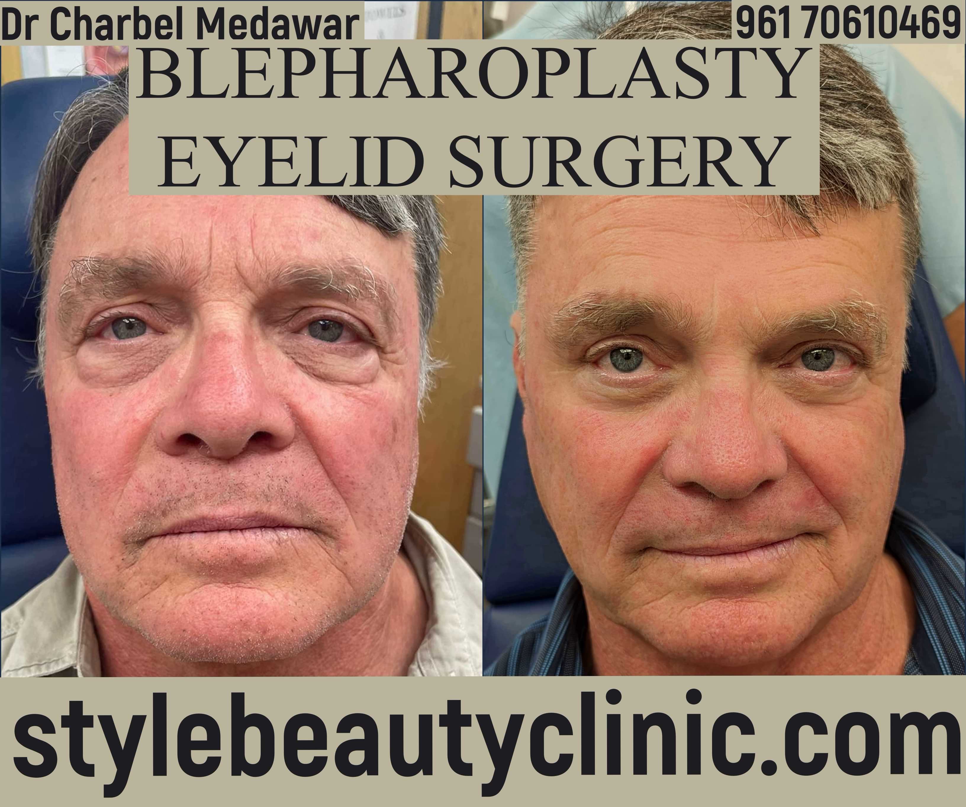 eyelid plastic surgery lebanon