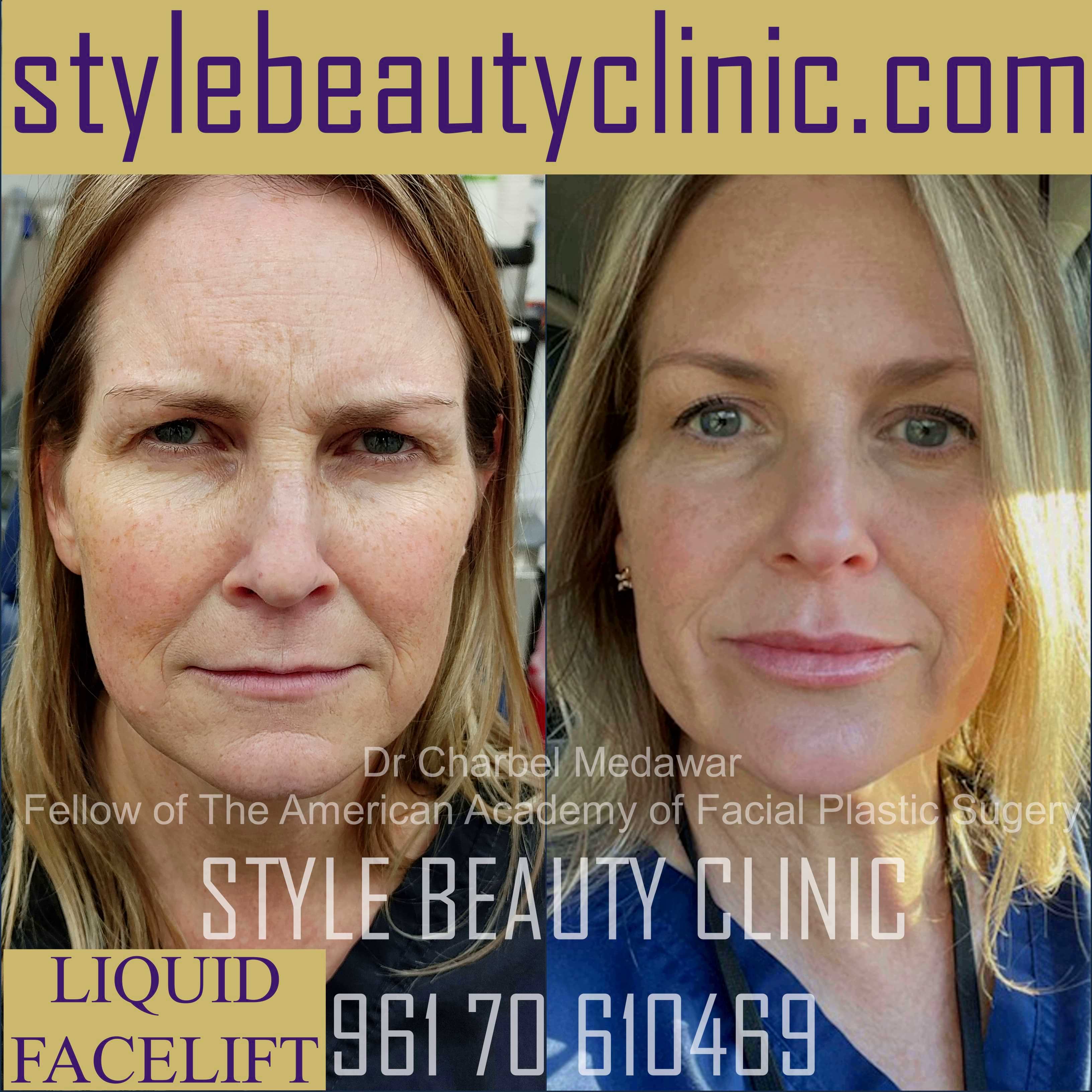 face lifting surgery lebanon