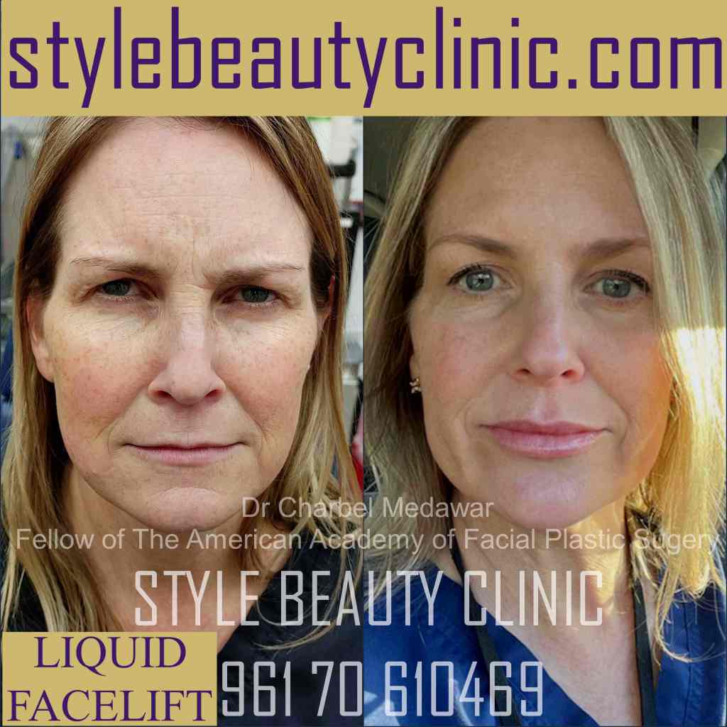 face lifting surgery lebanon