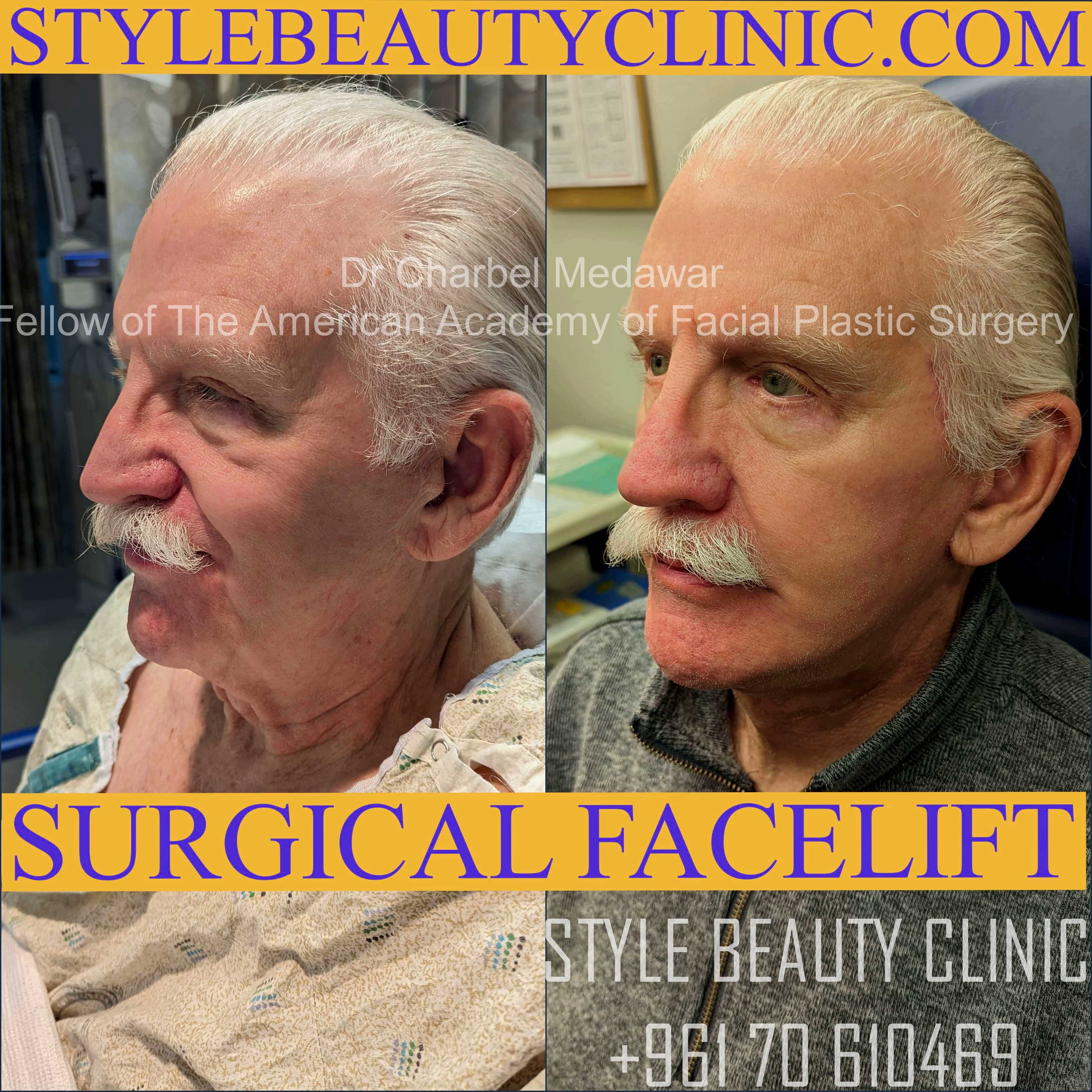 facial lifting lebanon