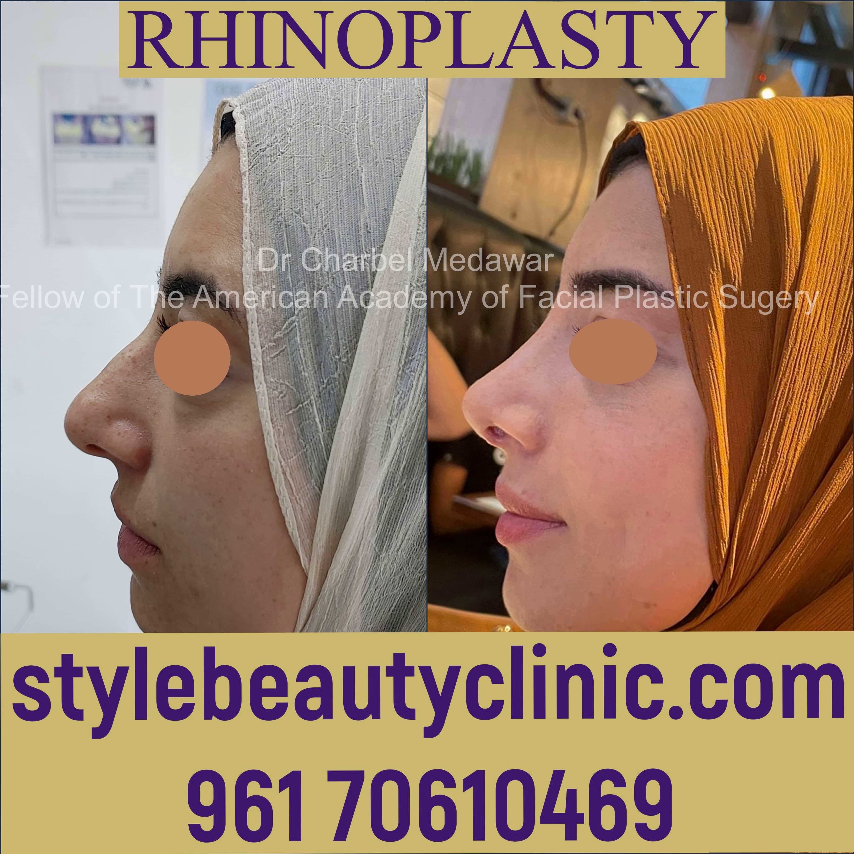 lebanon nose job