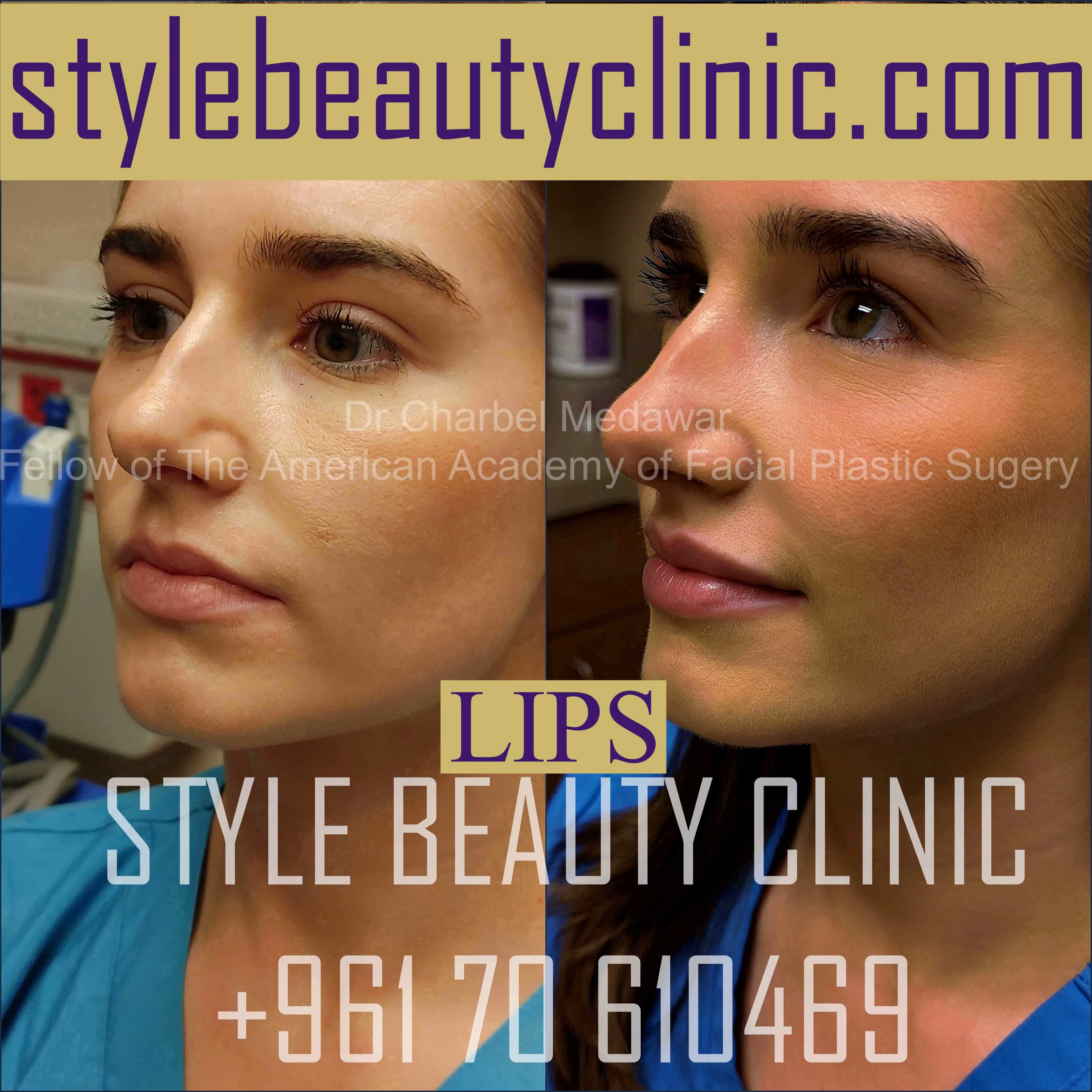 lip fillers lebanon price