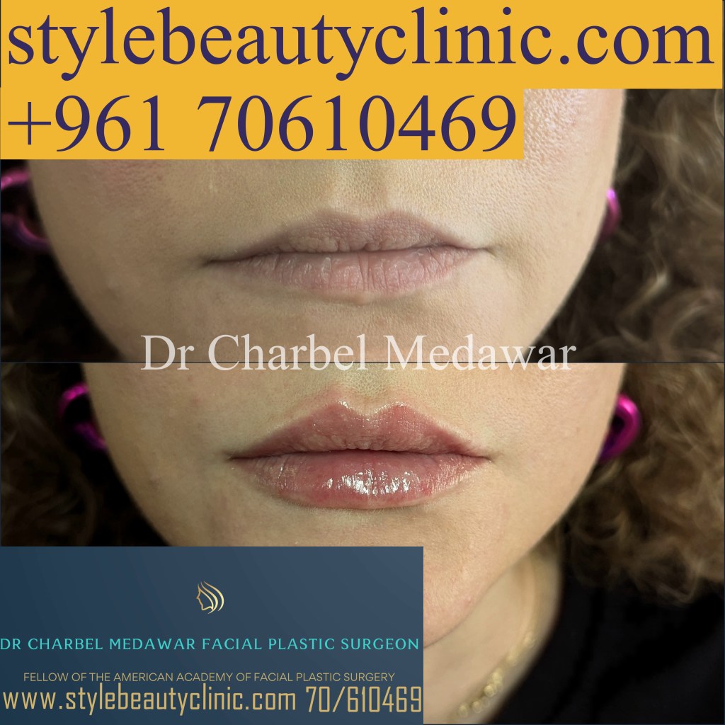 lip fillers lebanon price