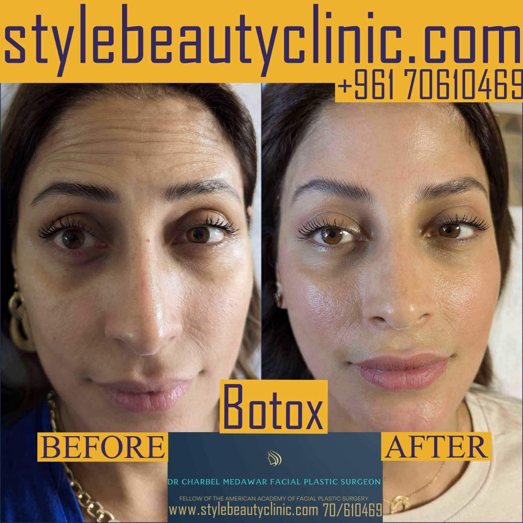 best botox in lebanon for hooded eyes dr charbel medawar