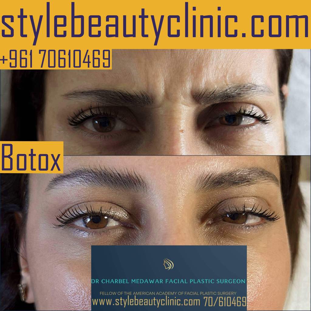 best botox lebanon dr charbel medawar