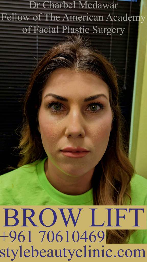 best brow lift fox eyes in lebanon dr charbel medawar
