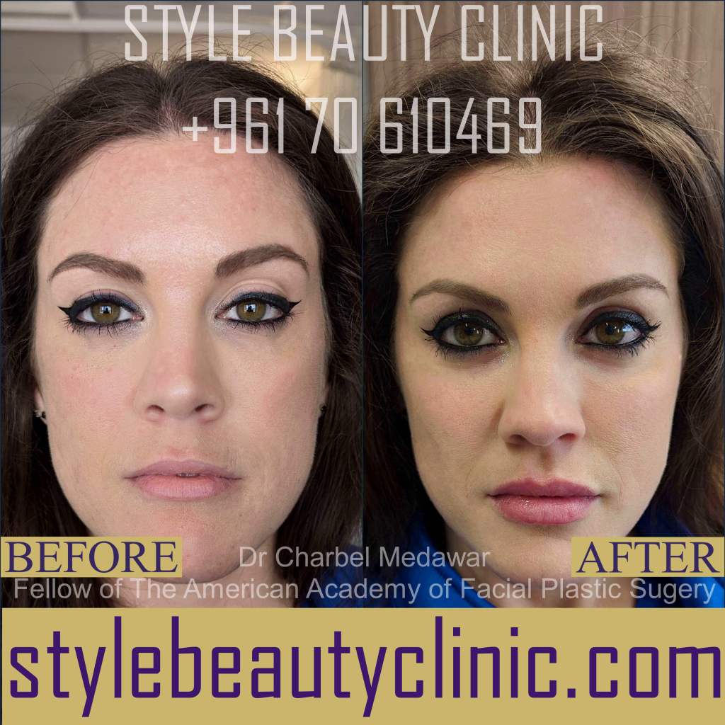 best cosmetic facial rejuvenation lebanon dr charbel medawar
